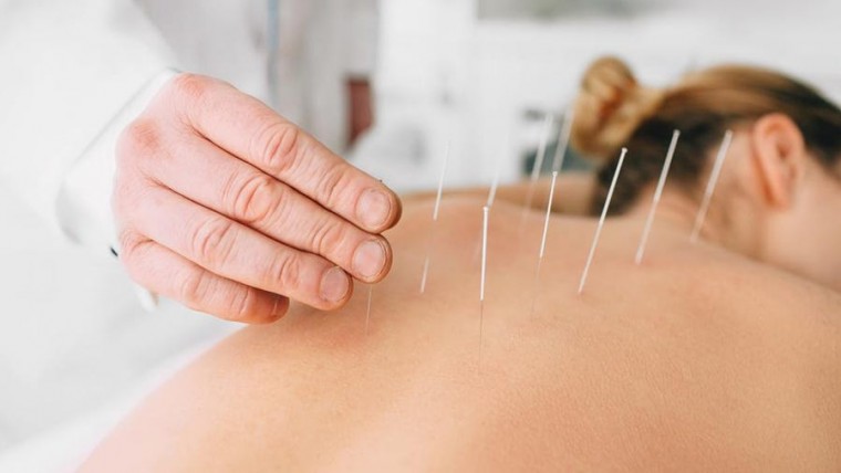Benefits of acupuncture
