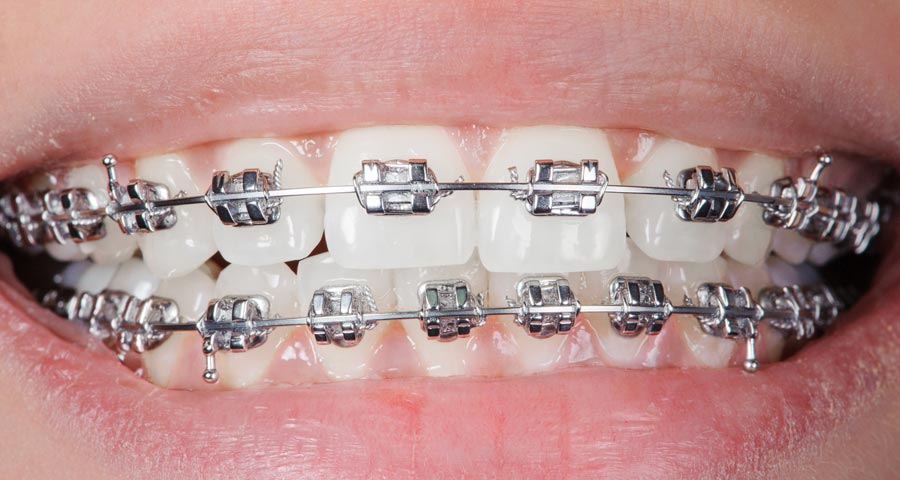 Dental Braces in London ON